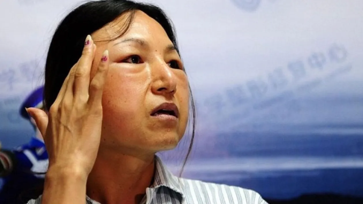 HORROR! Si-a făcut implant de pometi, dar va regreta vesnic ASTA! Si-a distrus complet chipul si arată ingrozitor