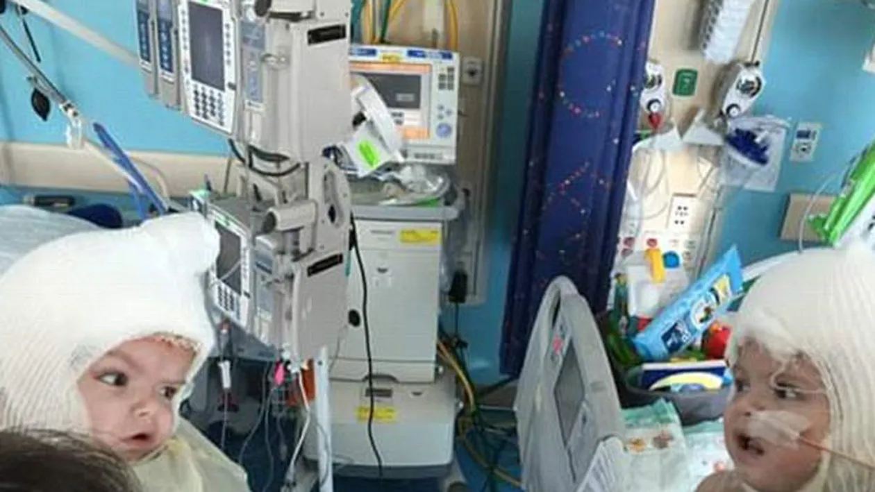 Emoţionant! Doi gemeni se privesc în ochi, după ce s-au născut lipiţi în zona capului