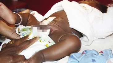 Cazul care a socat intreaga lume medicală! Un băietel s-a născut cu patru picioare: Doi bebelusi au crescut unul in celălalt