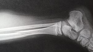 Neglijenţa cadrelor medicale poate fi fatală!O fetiţă de 4 ani a murit în urma unei fracturi la picior!