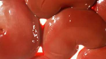 Rinichii romanilor saraci, transplantati ilegal intr-o clinica din Africa de Sud