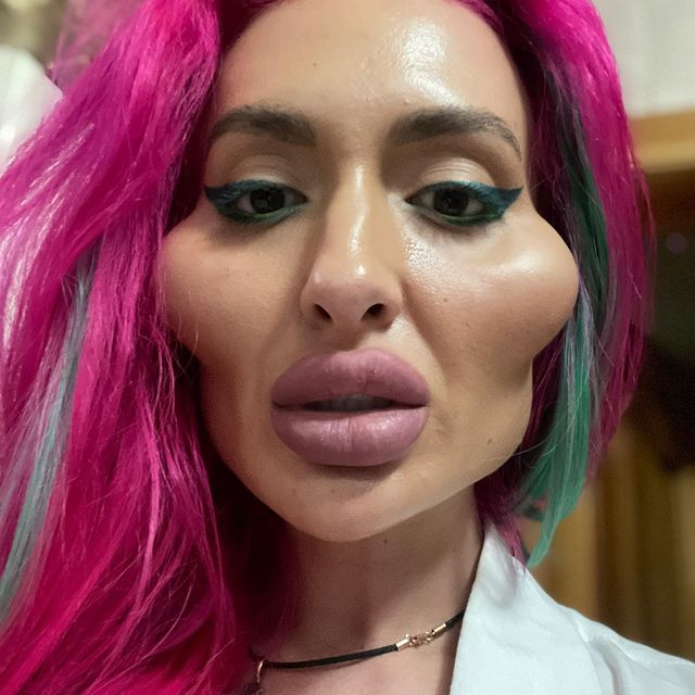 Cum a ajuns să arate o femeie dependentă de botox! Doctorii i-au spus să se oprească