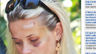 Uite cum arata Reese Witherspoon dupa ce a fost lovita de masina!