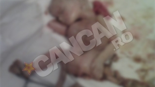 IMAGINI SOCANTE Caz foarte rar in lume! O femeie isi purta fatul mort de doua luni, in abdomen