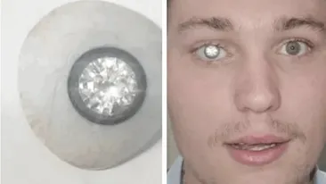 Povestea tânărului care și-a pus un diamant de 2 milioane de dolari în loc de ochi: ”A adus o lumină nouă în viața mea”