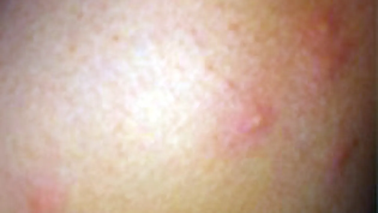 Doinita Oancea nu mai poate dormi: Am in jur de 50 de muscaturi pe maini si picioare care s-au umflat