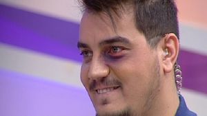 Adevărul din spatele ochiului vânăt al lui Bursucu'! Vezi ce s-a întâmplat cu prezentatorul TV
