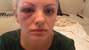 Imagini-soc! Alexandra Stan, snopita in bataie! “Accidentul a fost o inventie! Managerul meu m-a batut pana m-a bagat in spital”