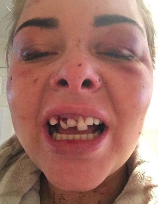 Un bărbat și-a bătut iubita și i-a spart trei dinți din cauză că a schimbat poza de pe Facebook și el nu mai apărea în ea