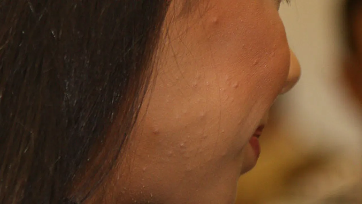 Sore si Elena de la Mandinga au o sora de suferinta. O prezentatoare TV are fata invadata de cosuri si nici machiajul n-o ajuta