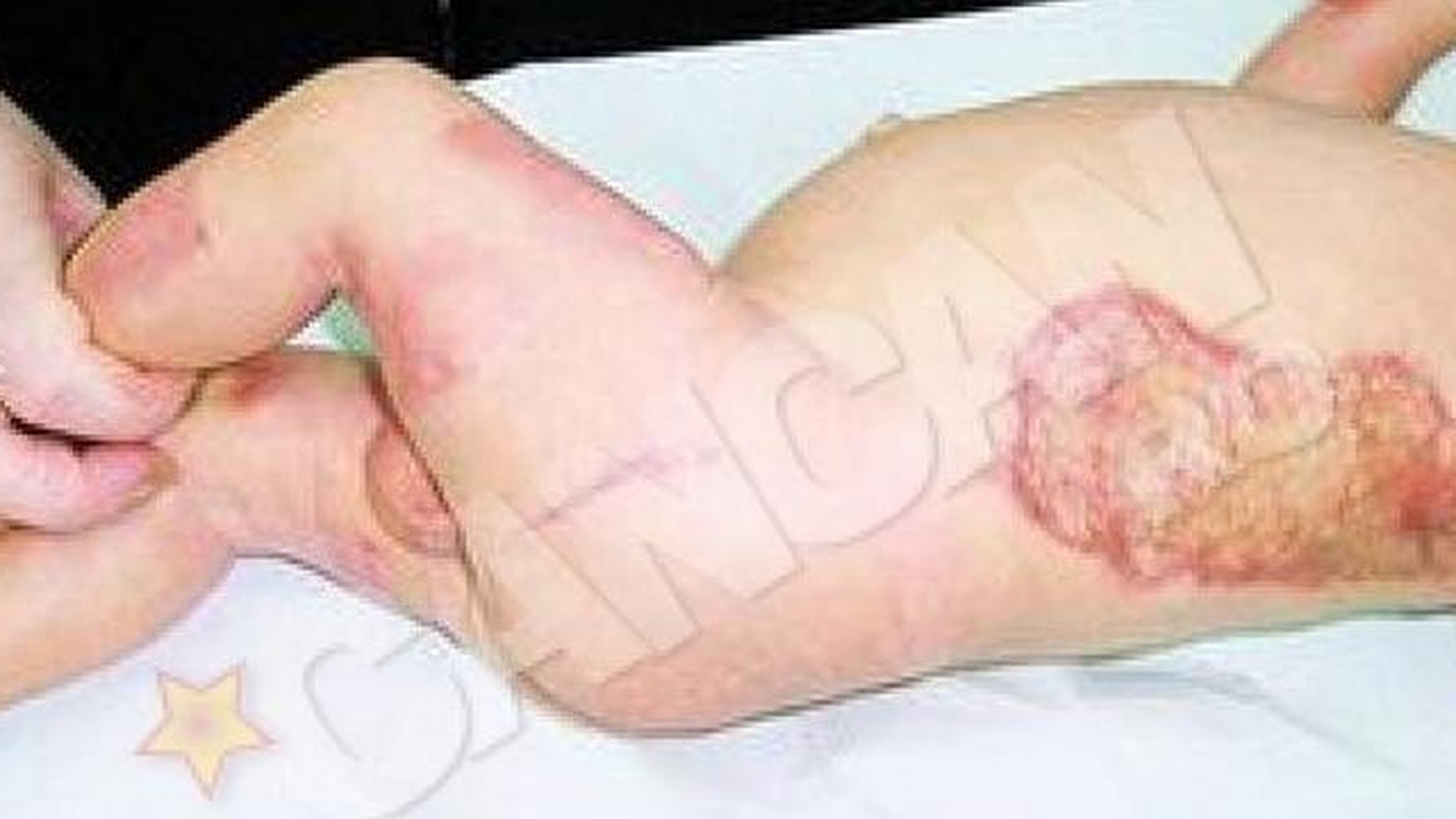 Cum a ajuns sa arate acum pielea carbonizata a baietelului care era sa arda de viu la Maternitatea Bucur!
