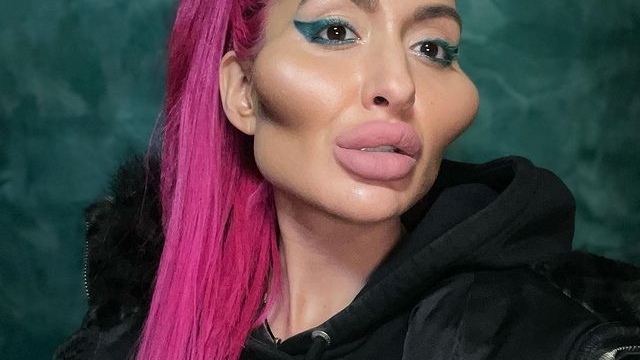Cum a ajuns să arate o femeie dependentă de botox! Doctorii i-au spus să se oprească