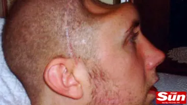 IMAGINE SOCANTA! Un pusti de 16 ani l-a lasat fara o bucata de cap