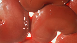 Rinichii romanilor saraci, transplantati ilegal intr-o clinica din Africa de Sud