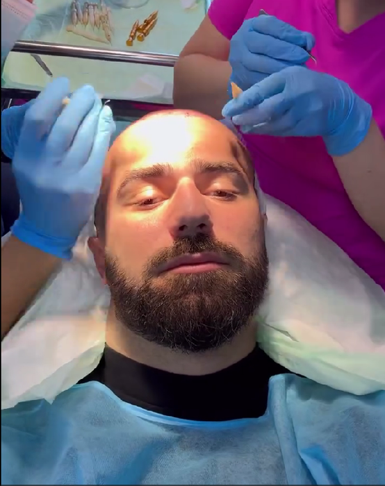 Andrei Stoica și-a făcut implant de păr/ Sursa foto: Instagram