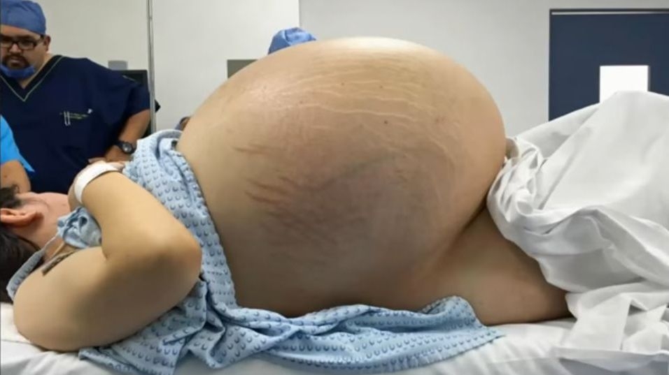 A avut o tumora la ovare care i-a ocupat 95% din abdomen. Ce s-a intamplat cu tanara dupa ce a fost consultata de medici 