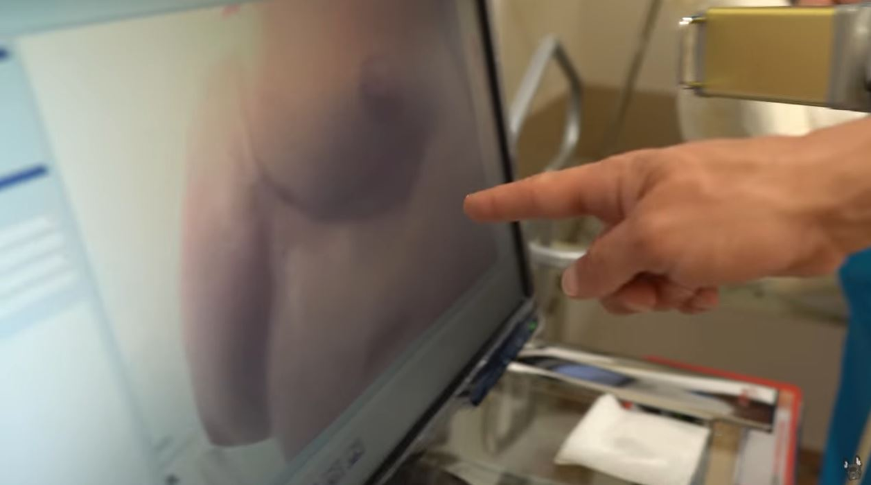 Dorian Popa, supus unei intervenții după ce a fost consultat de medic: “Sunt chisturi”. Problema medicală poate apărea la oricine are obiceiul dezvăluit de artist
