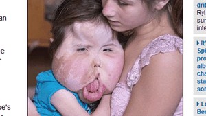 Cazul ei a pus în dilemă lumea medicală! O fetiţă din Anglia suferă de o boală care i-a mărit trăsăturile feţei anormal de mult