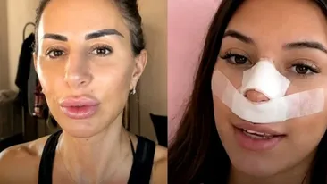 Val de reacții după ce o influenceriță s-a operat, pentru ca viitorii copii să nu îi moștenească nasul