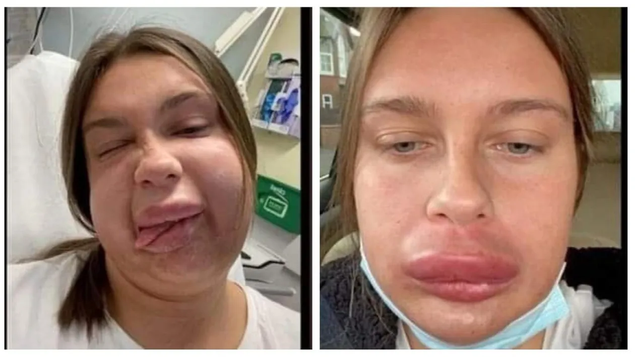 A vrut să aibă buze cărnoase și senzuale, dar a trecut printr-un adevărat coșmar. Ce a pățit o tânără din Londra