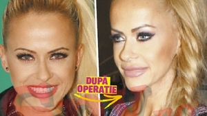 "Buzele tale, operate-n graba mare" Anda Adam, cap de lista in topul operatiilor estetice terminate prost!