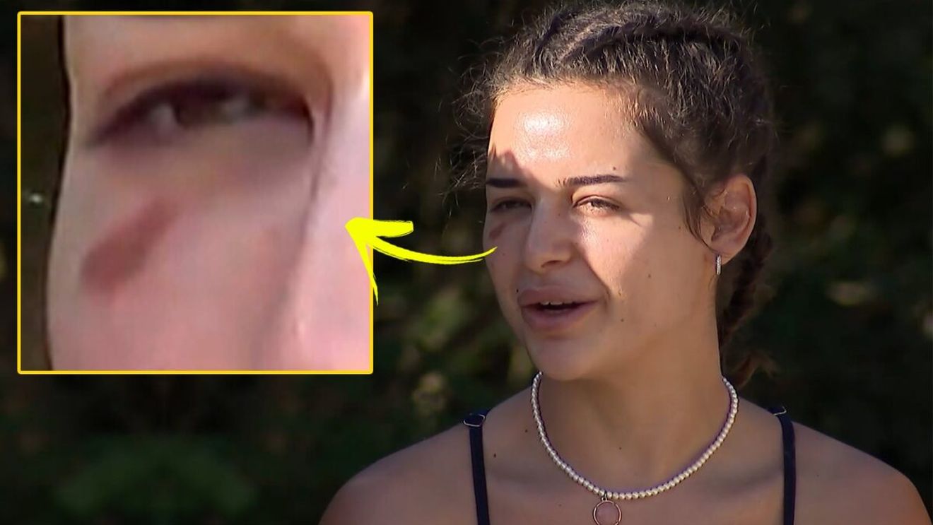 Oana Ciocan, cu o lovitură suspectă la Survivor All Stars. Ce a pățit iubita lui Jador, de fapt