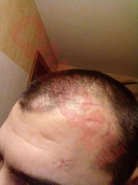 Urmele bătăii încasate de Matei Mihai Alexandru de la membrii clanului "Buricea"