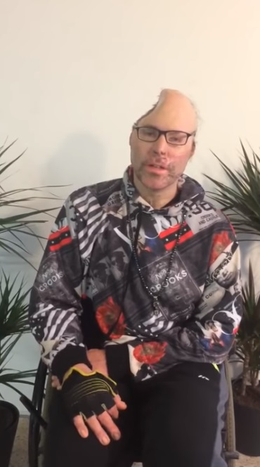Rapper-ul Dr Knarf, paralizat și mutilat și pe viață. Primele imagini după ce medicii i-au îndepărtat jumătate din cap în urma exploziei produsă la un laborator de droguri