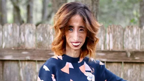 A fost catalogată “cea mai urâtă femeie din lume”, iar acum... Cum arată, în prezent, Lizzie Velasquez