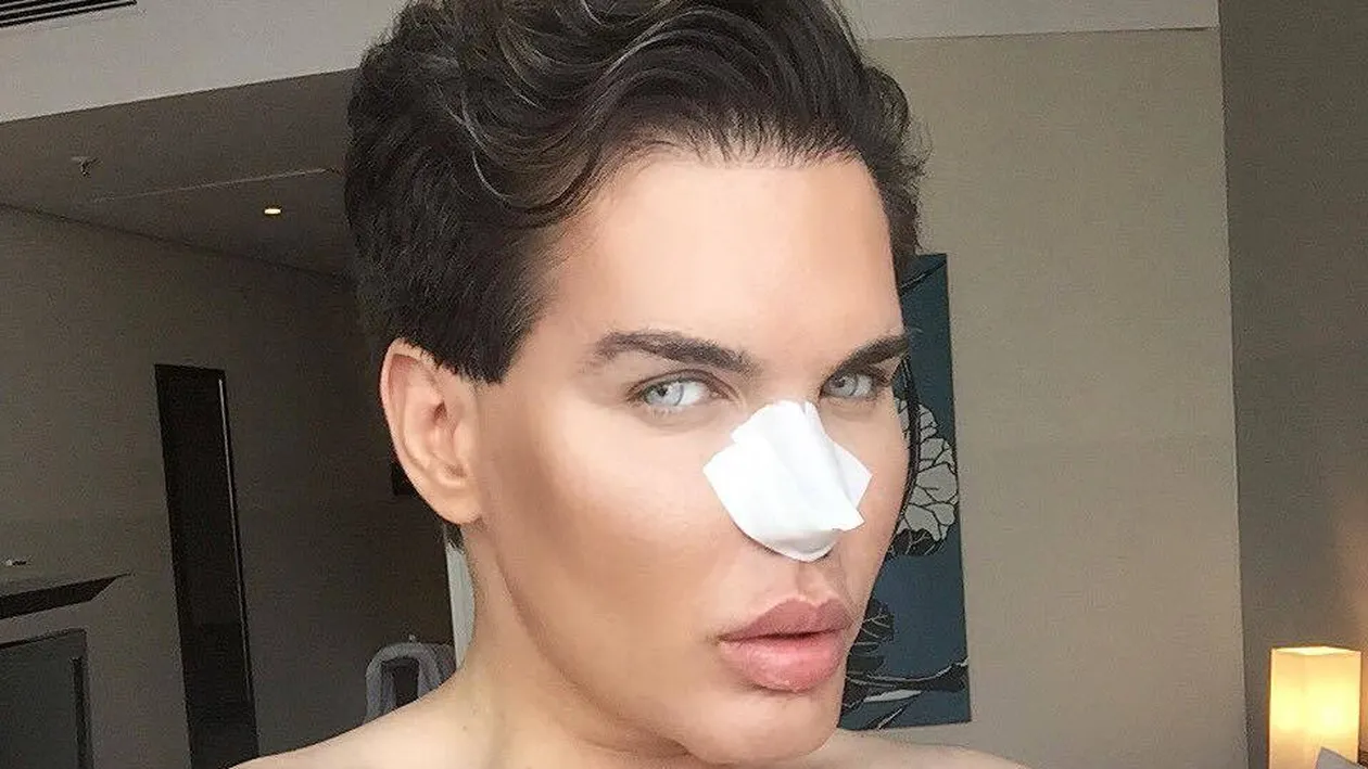 Bărbatul care şi-a făcut 43 de operaţii estetice pentru a semăna cu păpuşa KEN, probleme grave! Nasul acestuia a început să putrezească