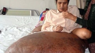 Un vietnamez este operat pentru a scapa de o tumora ce cantareste 90 de kilograme