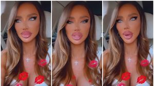 De ce își topește Bianca Drăgușanu acidul din buze. Vedeta a recunoscut ce s-a întâmplat