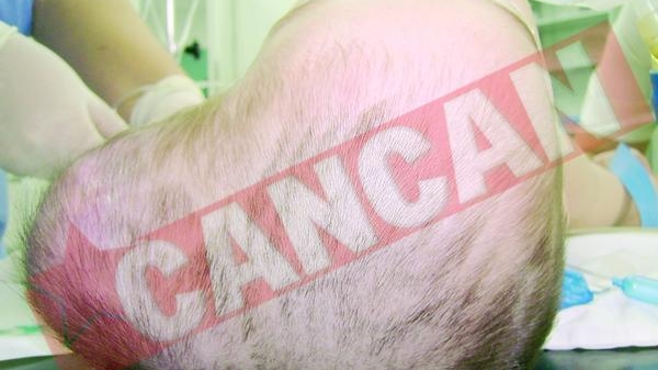 Un baietel de un an traia cu o tumora uriasa la cap