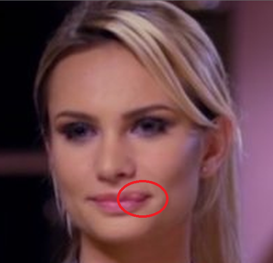 Bianca de la „Insula Iubirii” şi-a şocat admiratorii. A dorit să-şi mărească buzele, dar operaţia a fost greşită. „Când s-a resorbit serul…”