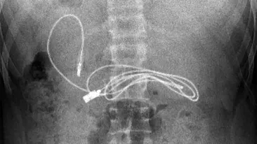 Medicii au crezut că nu văd bine! Ce gadget au putut găsi în stomacul unui adolescent care acuza dureri de burtă