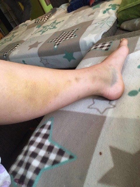 Medicii i-au montat tije în picior lui Dee Dee, în urma accidentului