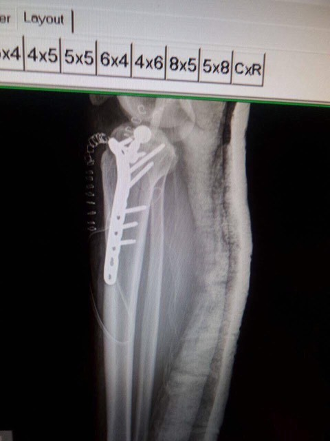 Radiografia piciorului lui Dee Dee de la ”Insula iubirii”