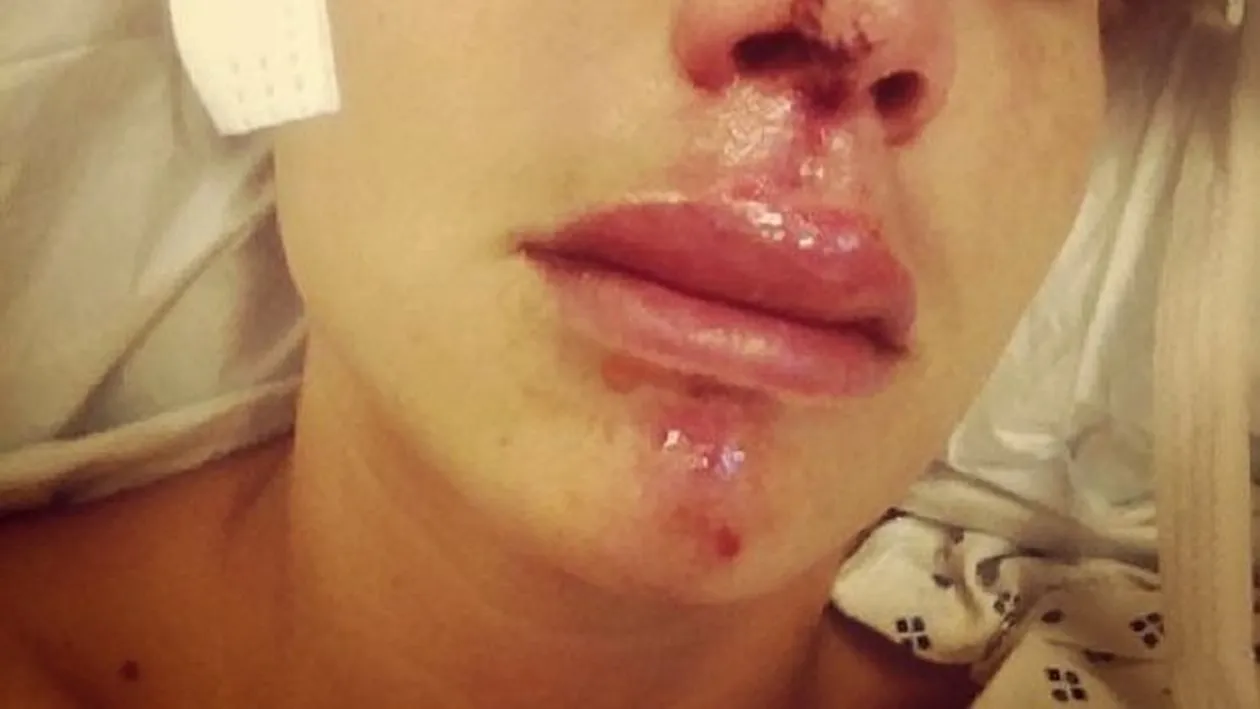 ŞOCANT! O gimnastă a fost desfigurată! Blonda superbă a fost mutilată după ce a încercat o cascadorie simplă!