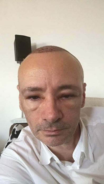 Aşa arăta Mihai Albu după implant