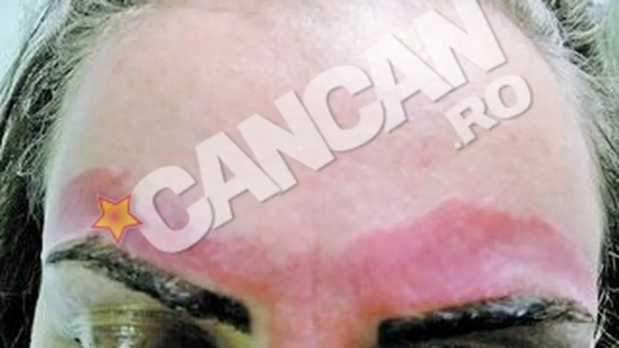 O suceveanca a ajuns la Spitalul de Urgenta din Iasi! Arsa pe fata de ceara de la cosmetica