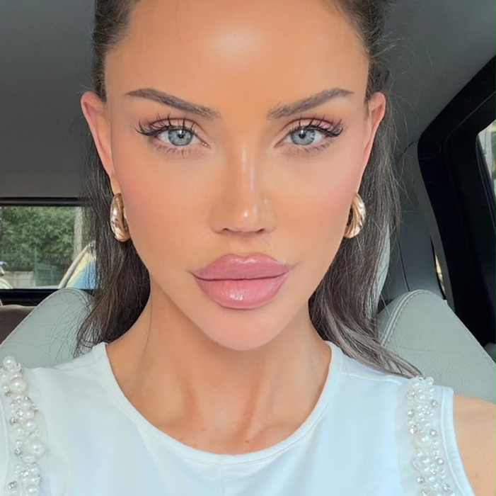Cum arată Bianca Drăgușanu după ce și-a operat urechile. Cum a decurs intervenția de otoplastie