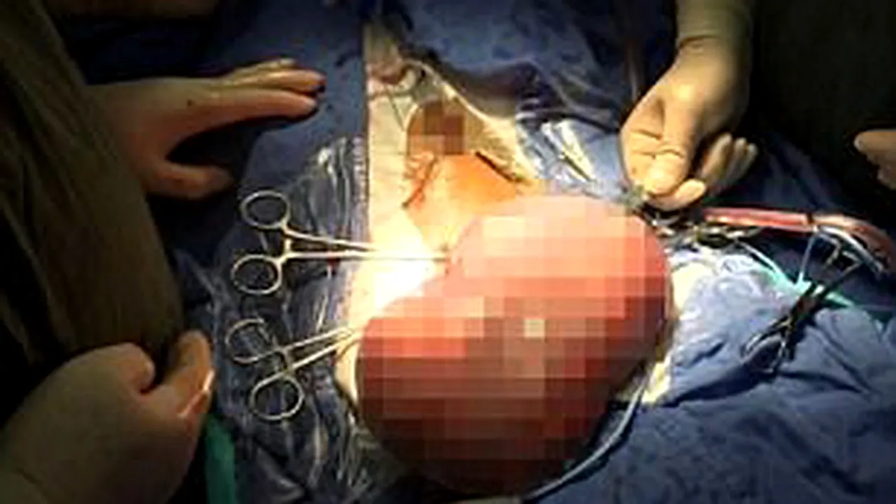 Un copil de opt ani a fost operat de urgenţă, după ce burta lui era pe punctul de a exploda pentru că nu putea merge la toaletă! Doctorii i-au scos 3 kg de excremente de mărimea unei mingi de baschet