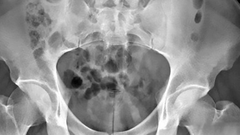 Halucinant! Medicii i-au scos din penis o jucărie sexuală de 20 cm, după ce dispozitivul i s-a blocat în vezică