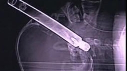 VIDEO A ajuns la spital cu o teava de 30 cm infipta in cap