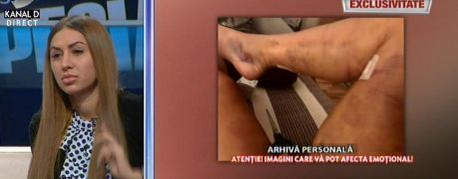 Denisa Despa a ajuns de urgență la bisturiu. Și-a mărit silicoanele… de nevoie! Cum a explicat intervenția!