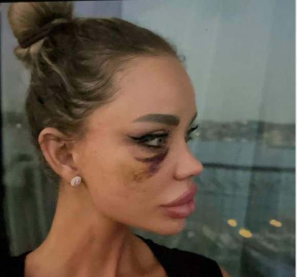 Bianca Drăgușanu, hotărâtă să facă plângere penală împotriva lui Alex Bodi, după apariția filmulețului cu ea inconștientă