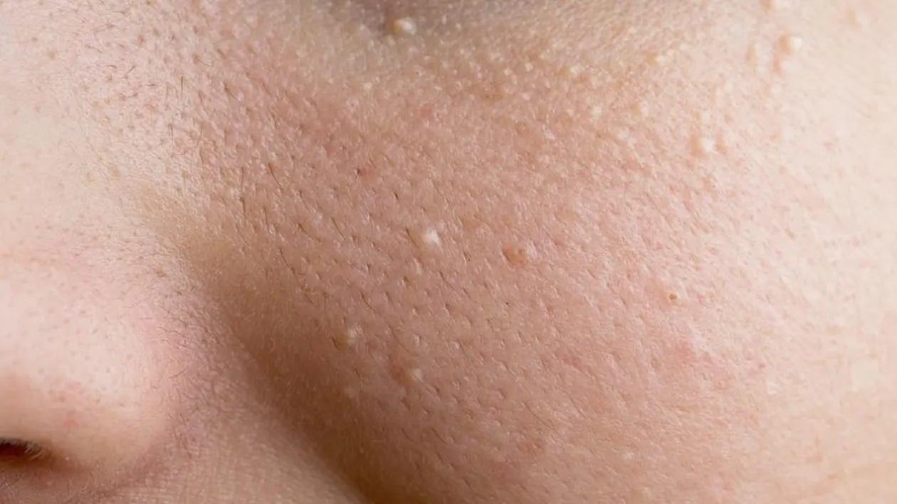 Cum poţi scăpa de punctele albe de pe ten. Reţeta care face minuni