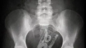 Sa vezi si sa nu crezi! Cele mai ciudate lucruri pe care oamenii si le baga in fund!