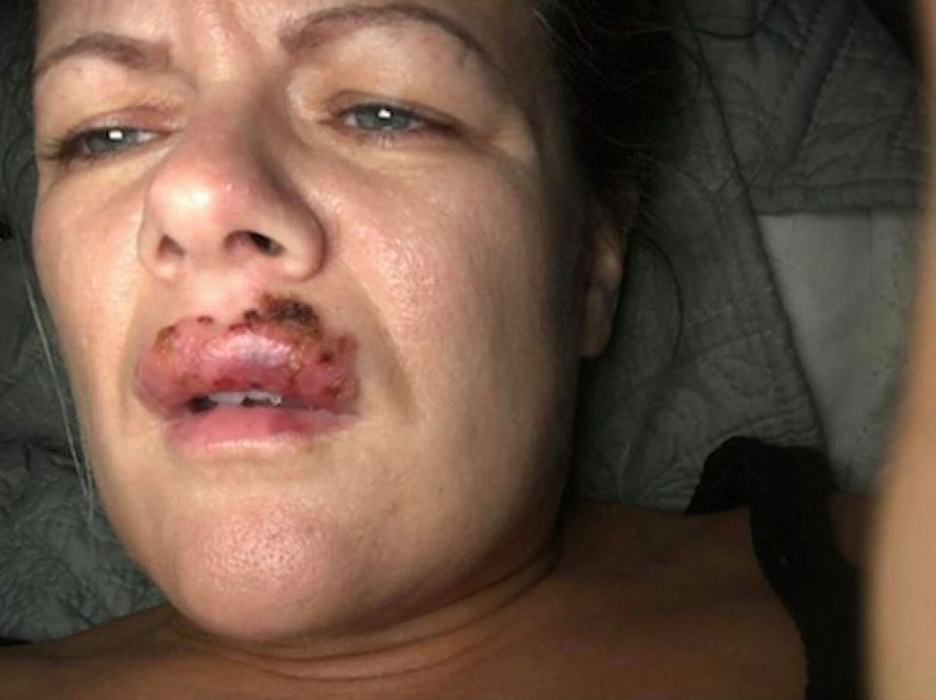 Prin ce dramă a trecut o femeie, după ce și-a mărit buzele: ”Aș fi putut să îmi pierd vederea”
