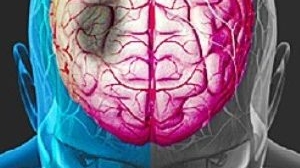 Cel mai rapid mijloc de diagnosticare a accidentului cerebral de către nespecialiști